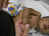 Dermal melanocytosis